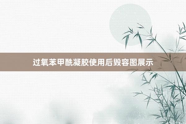 过氧苯甲酰凝胶使用后毁容图展示